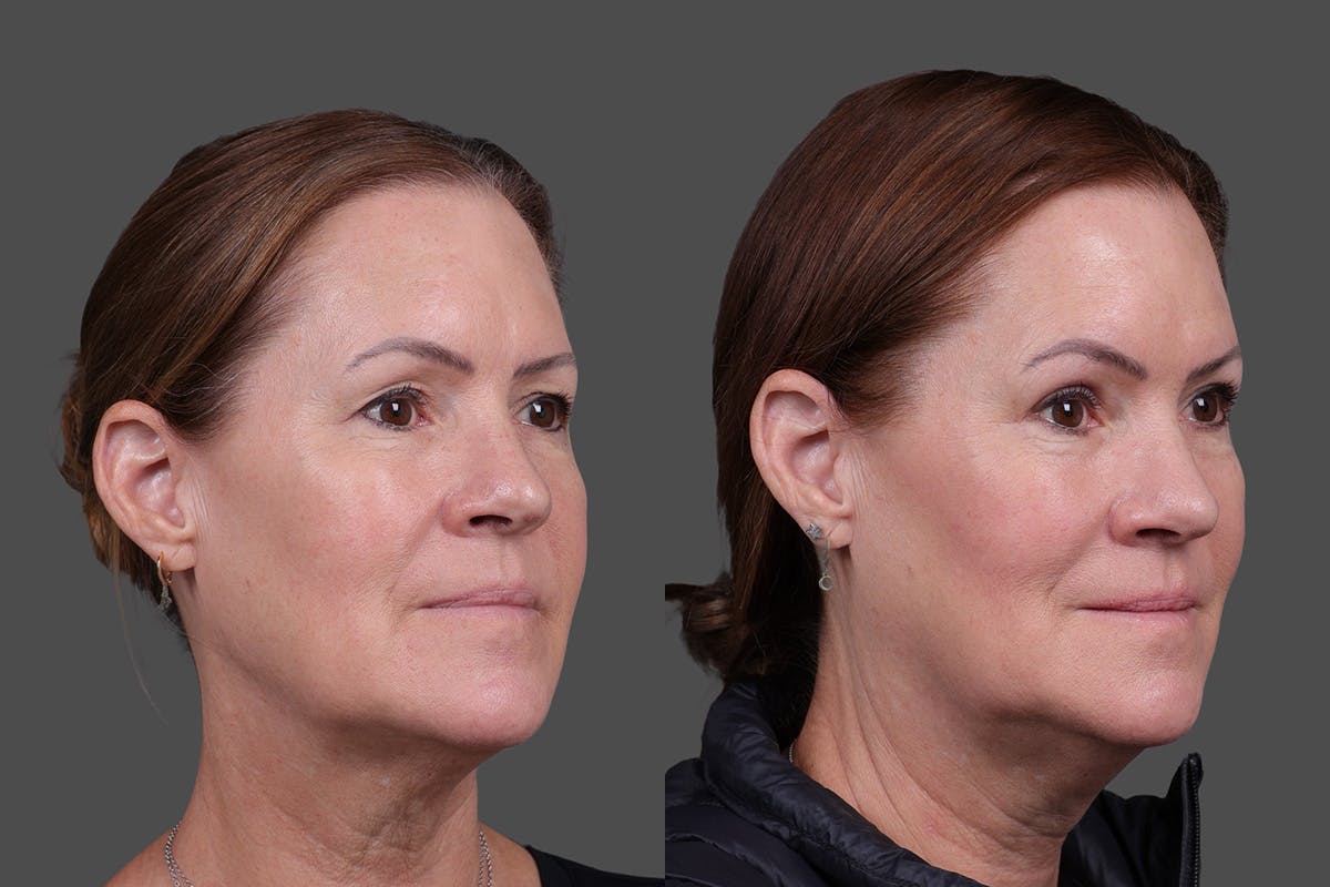 Eyelid Surgery (Blepharoplasty) Before & After Gallery - Patient 138195 - Image 2