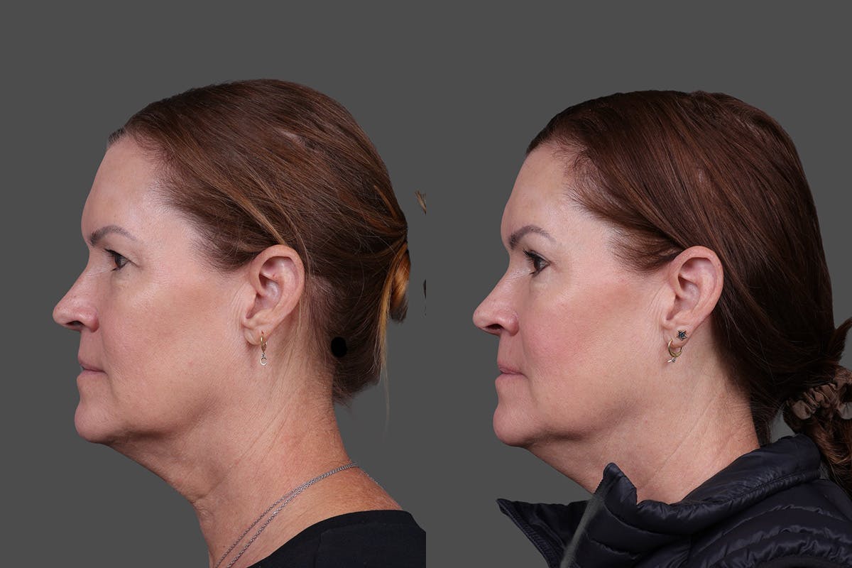 Eyelid Surgery (Blepharoplasty) Before & After Gallery - Patient 138195 - Image 5