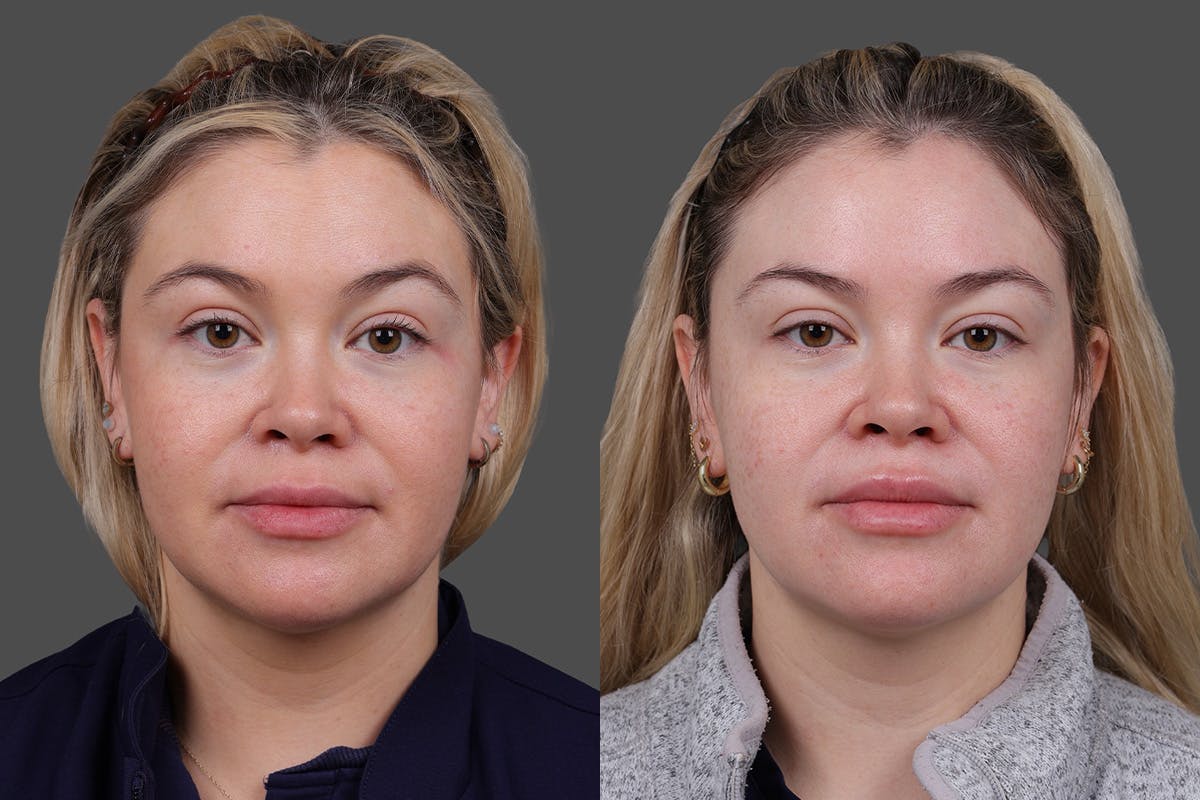 Revance RHA Before & After Gallery - Patient 391841 - Image 1