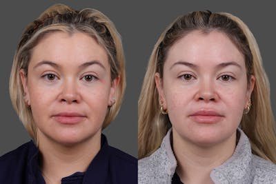 Dysport Before & After Gallery - Patient 169023 - Image 1