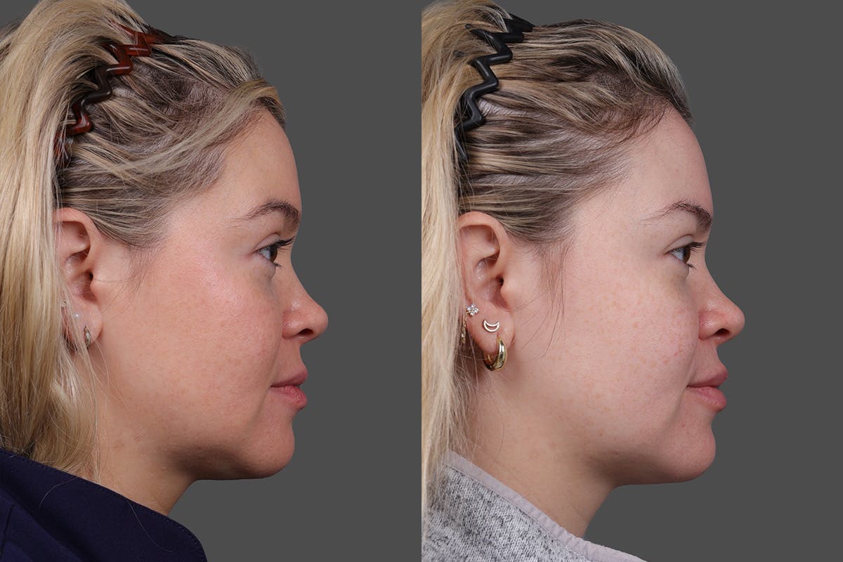 Revance RHA Before & After Gallery - Patient 391841 - Image 5