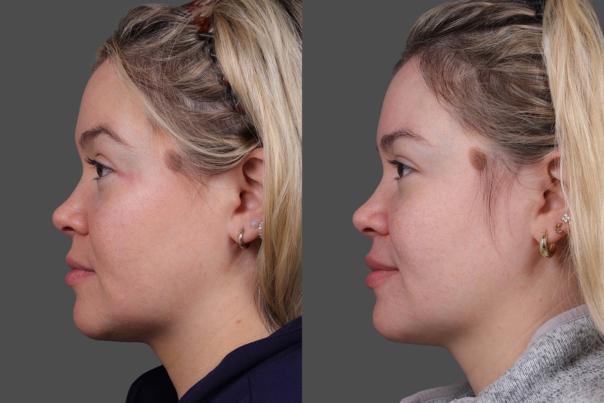 Revance RHA Before & After Gallery - Patient 391841 - Image 7