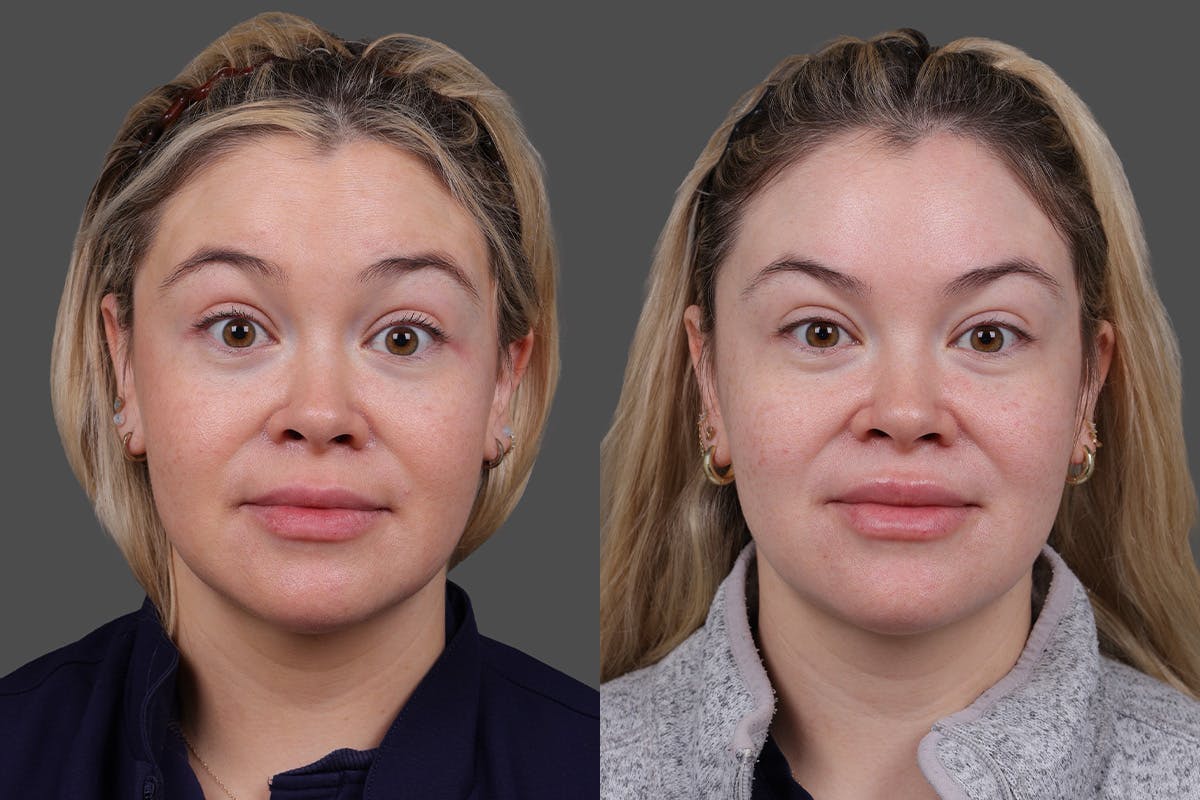 Revance RHA Before & After Gallery - Patient 391841 - Image 2