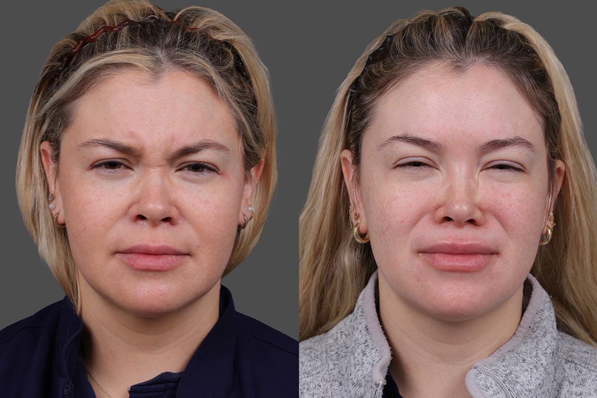 Revance RHA Before & After Gallery - Patient 391841 - Image 3