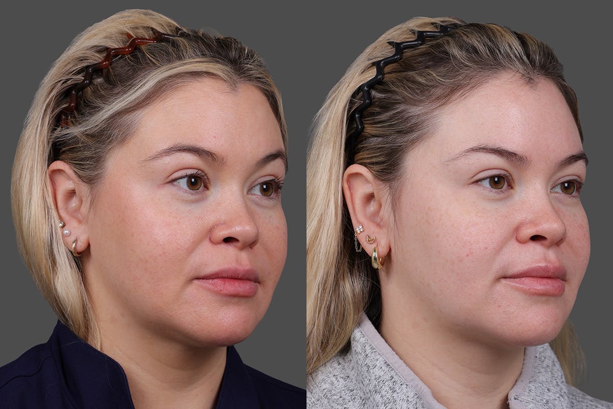 Revance RHA Before & After Gallery - Patient 391841 - Image 4