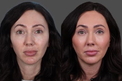 Eyelid Surgery (Blepharoplasty) Before & After Gallery - Patient 299393 - Image 1