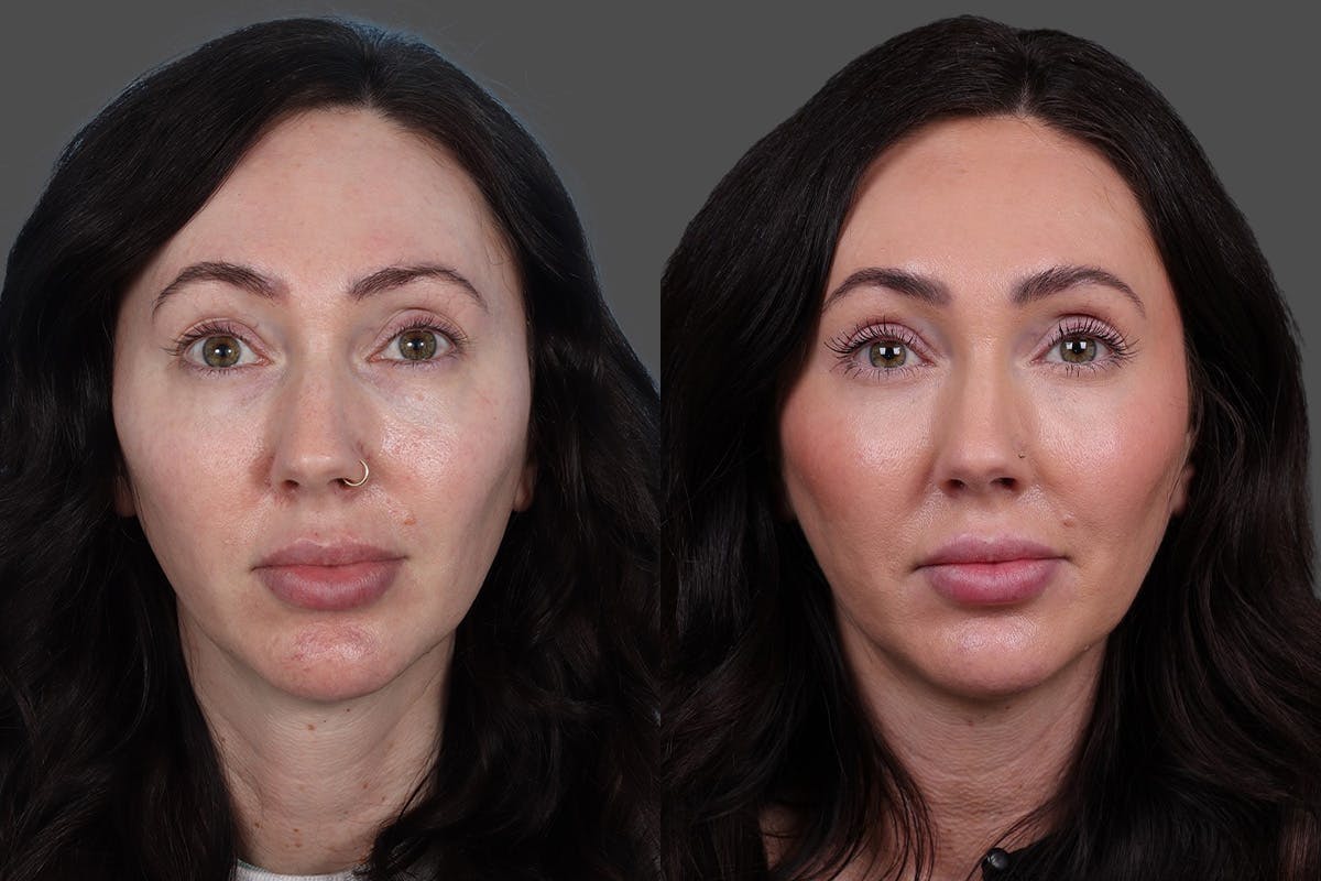 Eyelid Surgery (Blepharoplasty) Before & After Gallery - Patient 299393 - Image 1