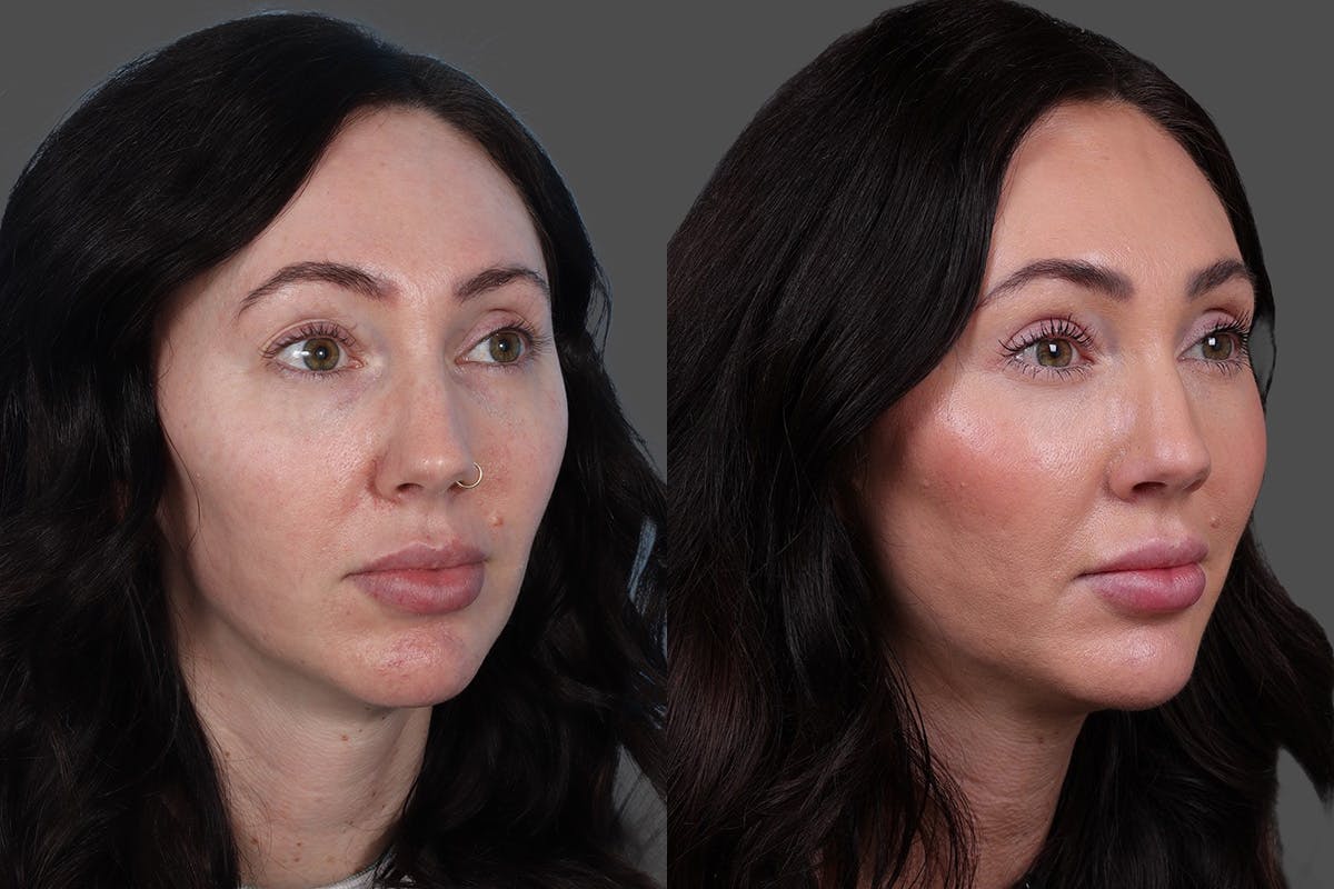 Eyelid Surgery (Blepharoplasty) Before & After Gallery - Patient 299393 - Image 2