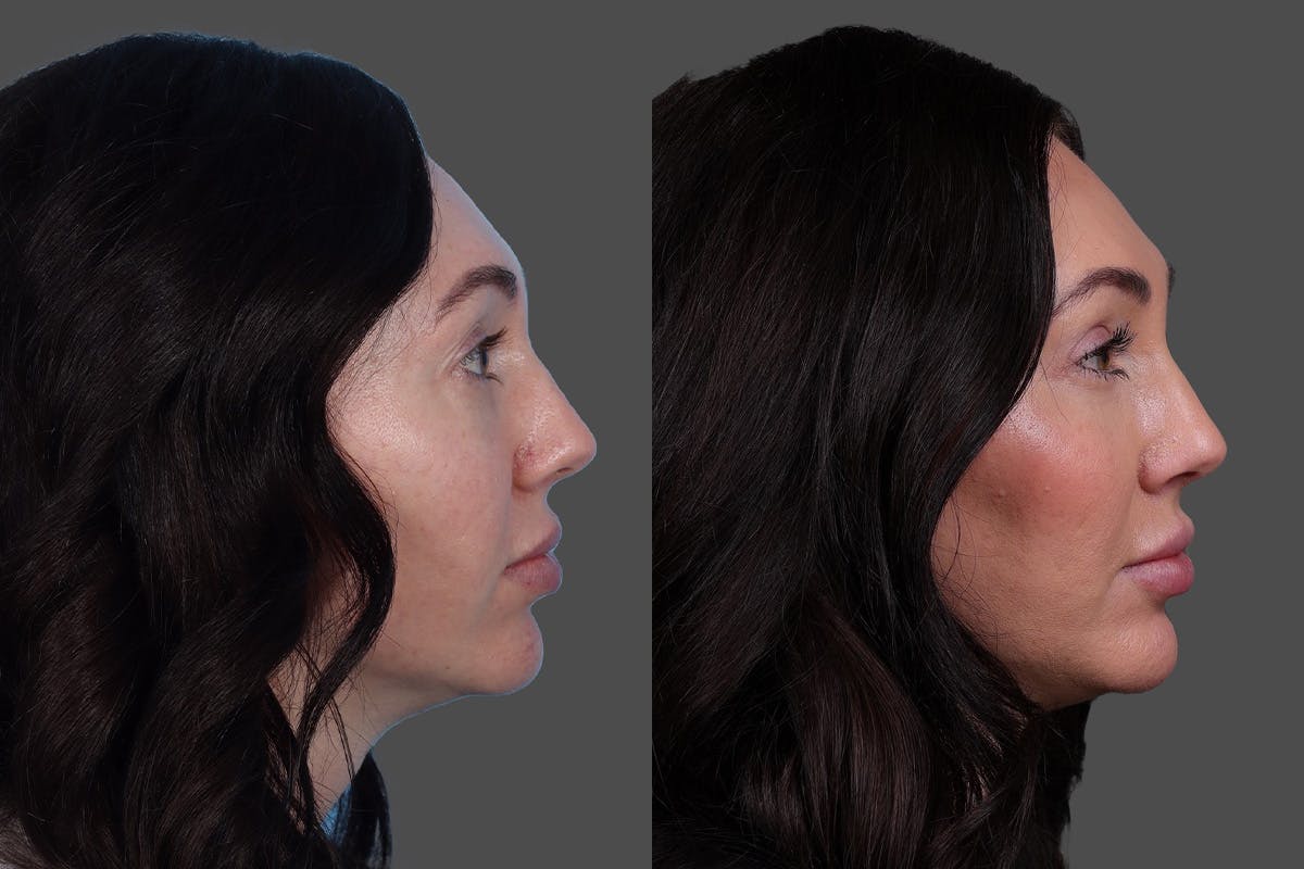 Eyelid Surgery (Blepharoplasty) Before & After Gallery - Patient 299393 - Image 3