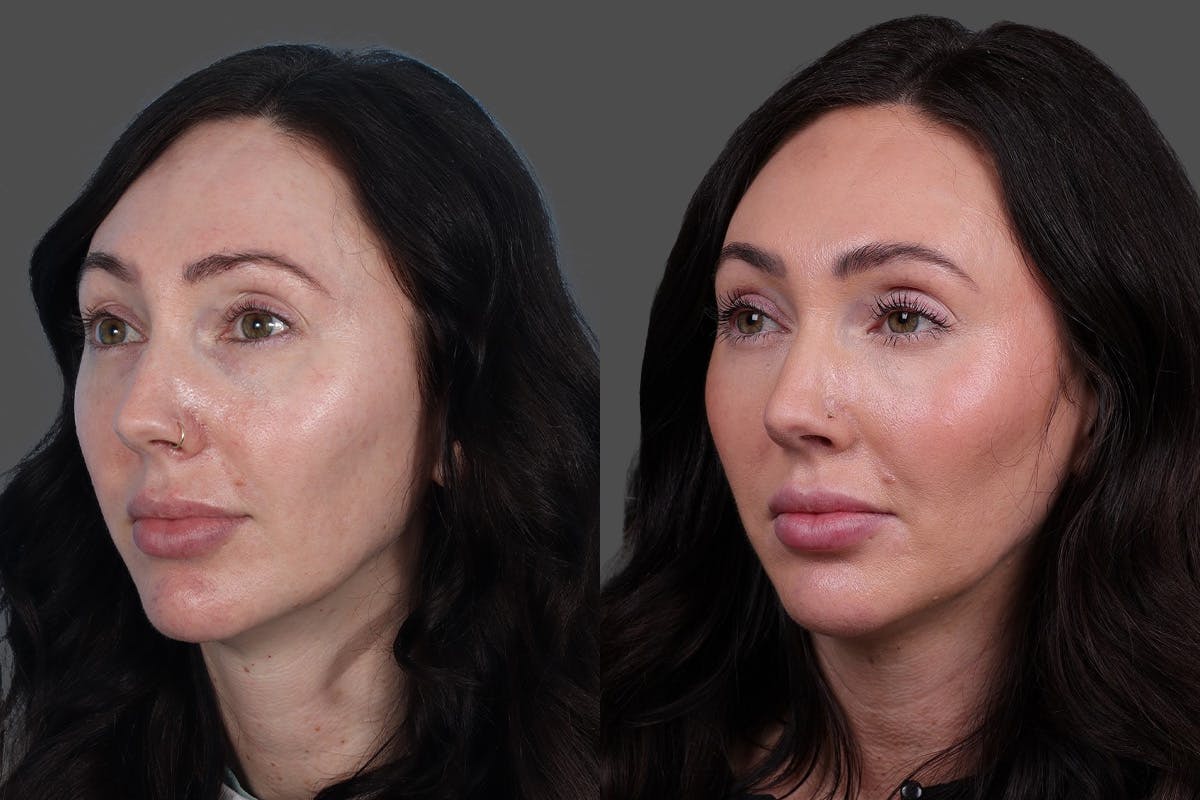 Eyelid Surgery (Blepharoplasty) Before & After Gallery - Patient 299393 - Image 4