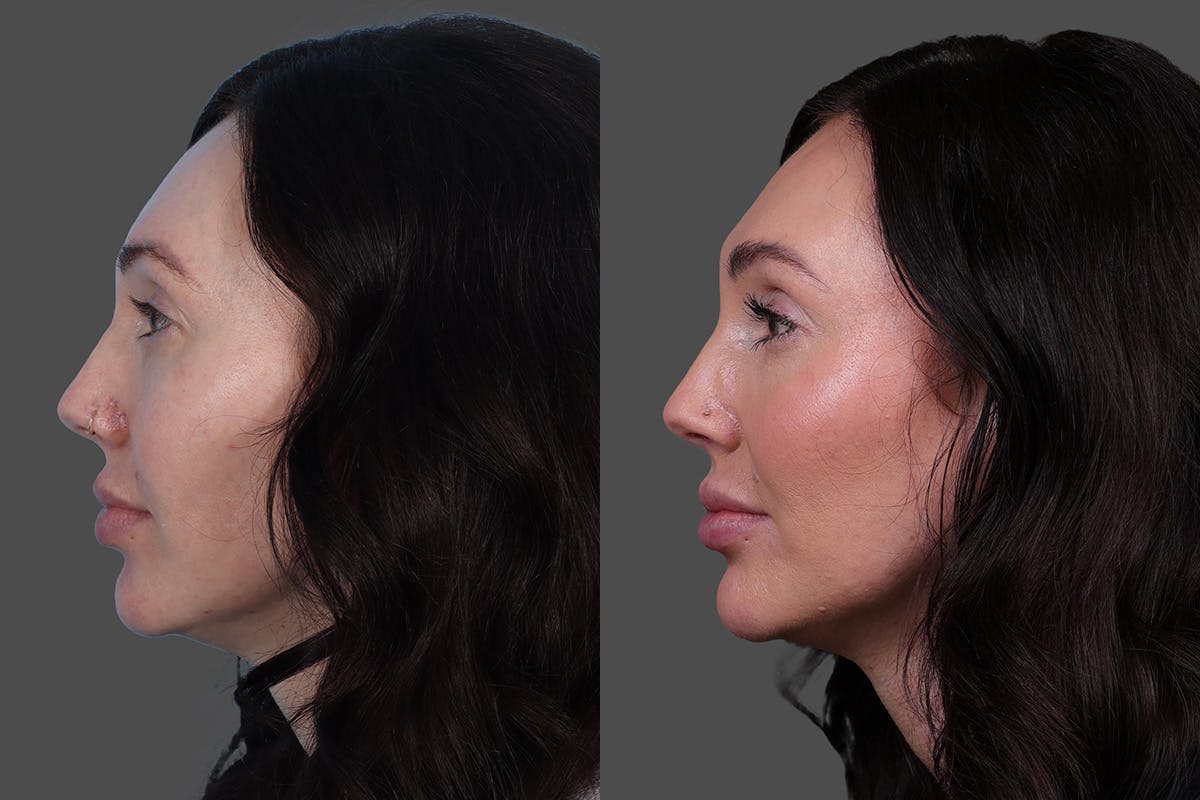 Eyelid Surgery (Blepharoplasty) Before & After Gallery - Patient 299393 - Image 5
