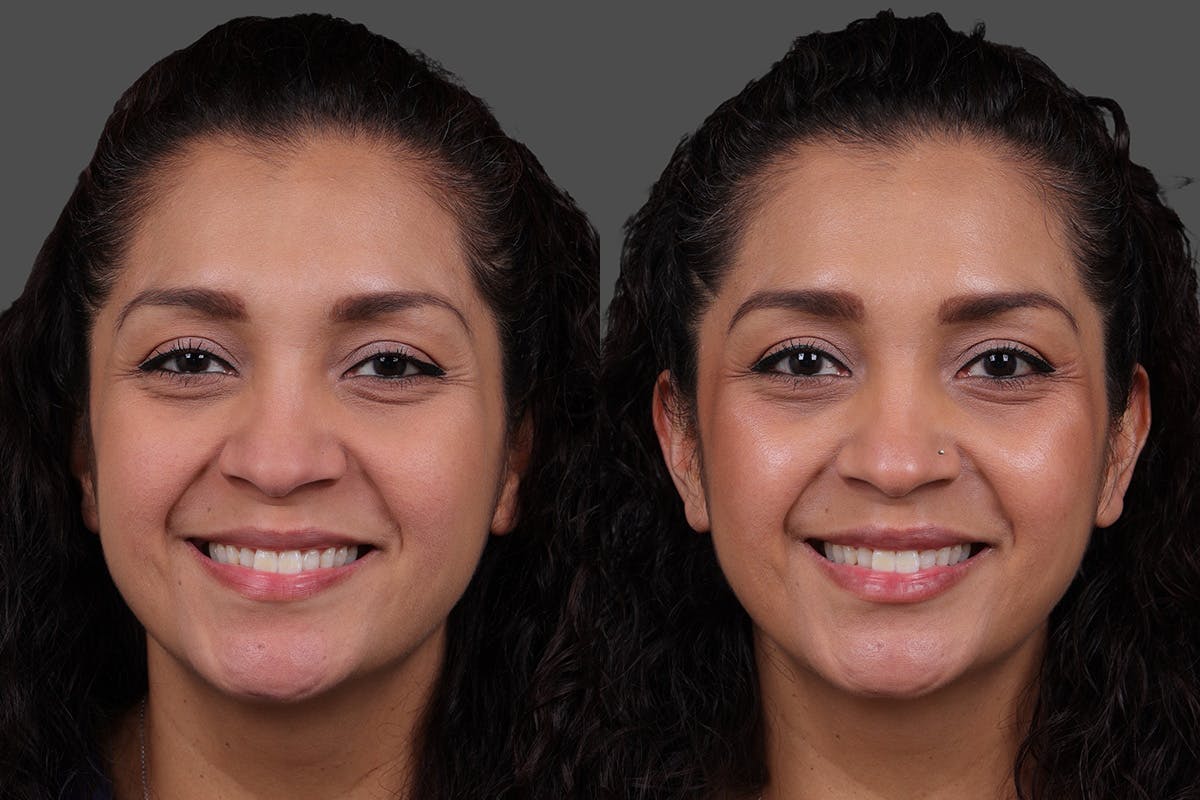 Restylane Before & After Gallery - Patient 157851 - Image 1