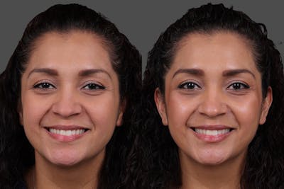Restylane Before & After Gallery - Patient 157851 - Image 1