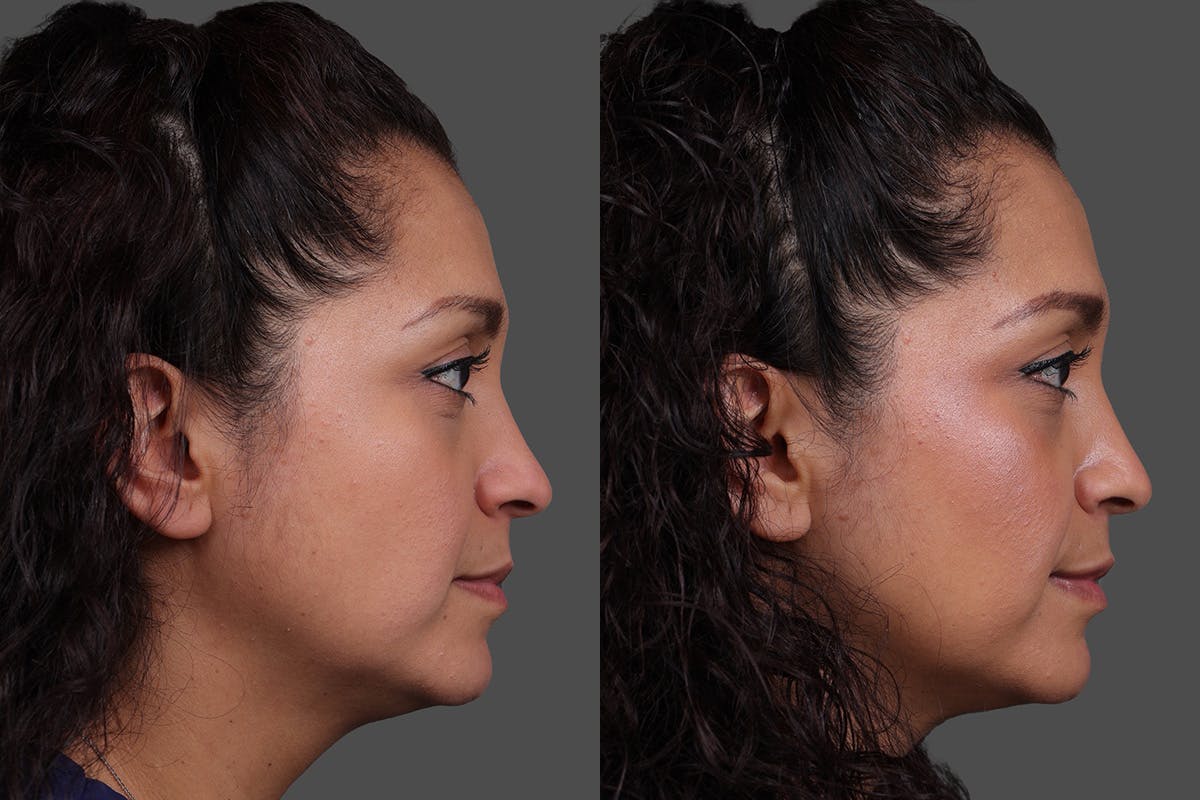 Restylane Before & After Gallery - Patient 157851 - Image 3