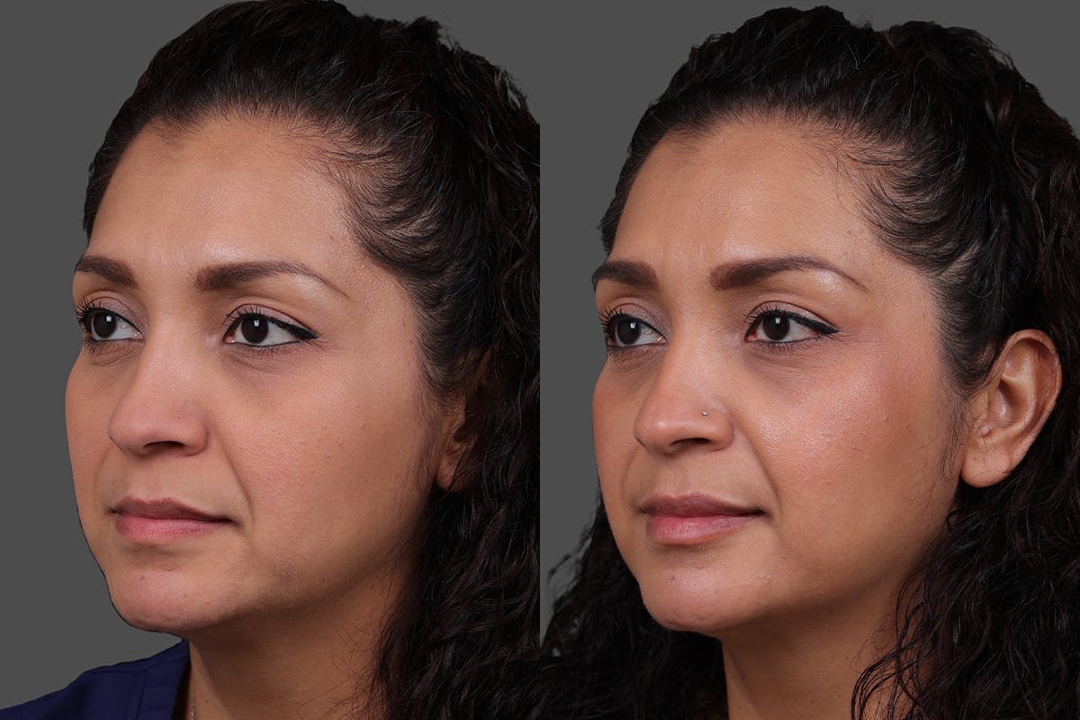 Restylane Before & After Gallery - Patient 157851 - Image 4