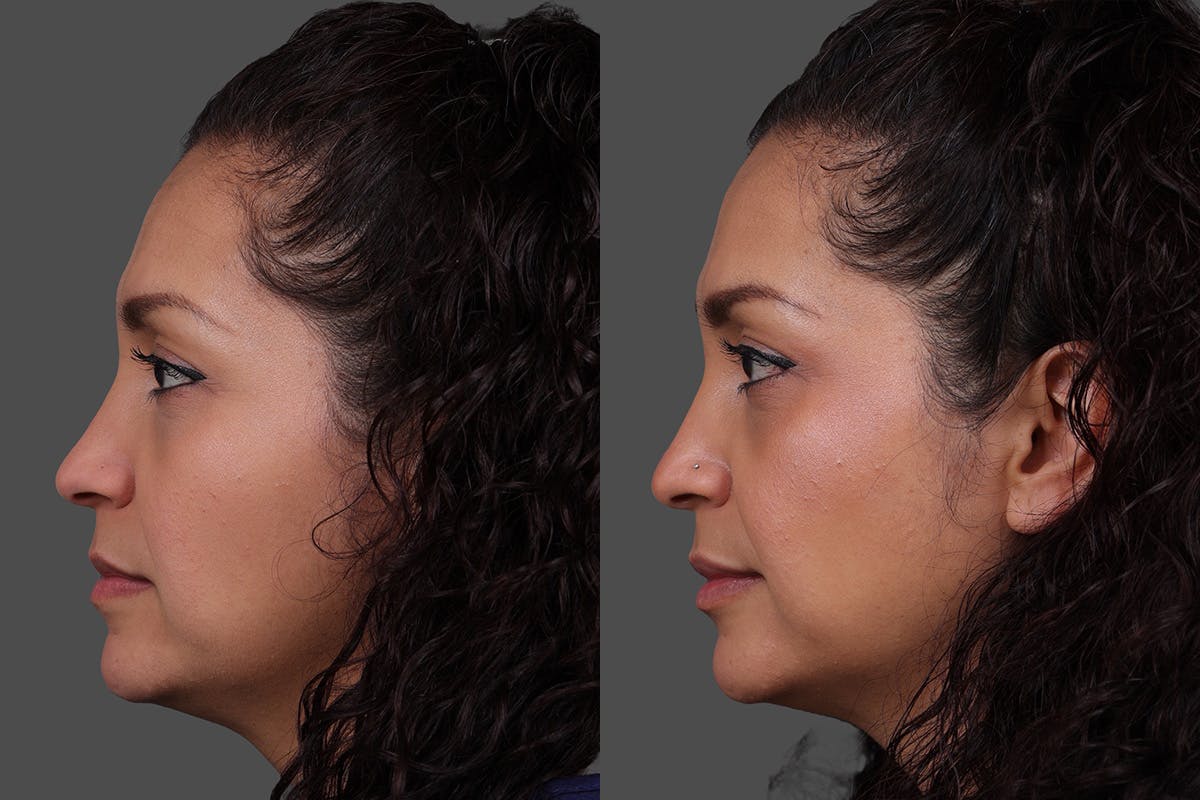 Restylane Before & After Gallery - Patient 157851 - Image 5