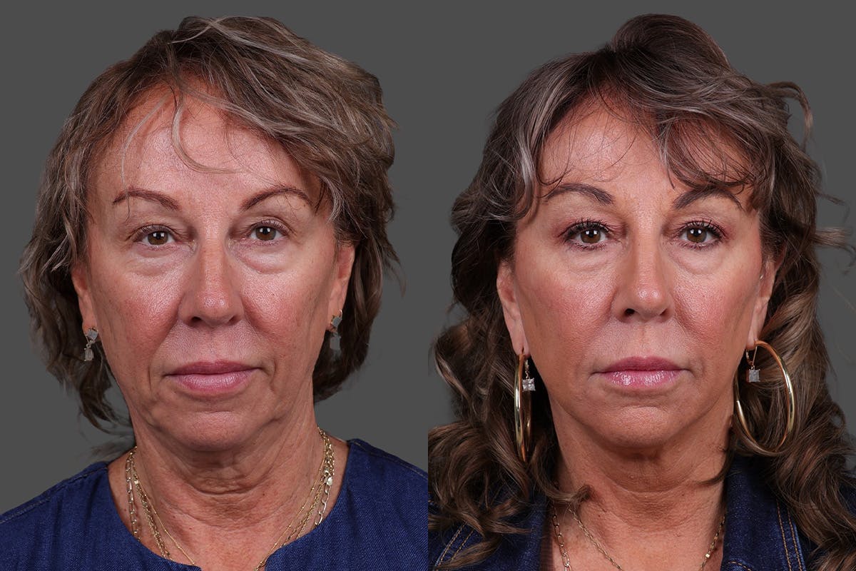 Limited Incision Facelift Before & After Gallery - Patient 290210 - Image 1