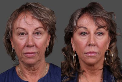 Limited Incision Facelift Before & After Gallery - Patient 290210 - Image 1