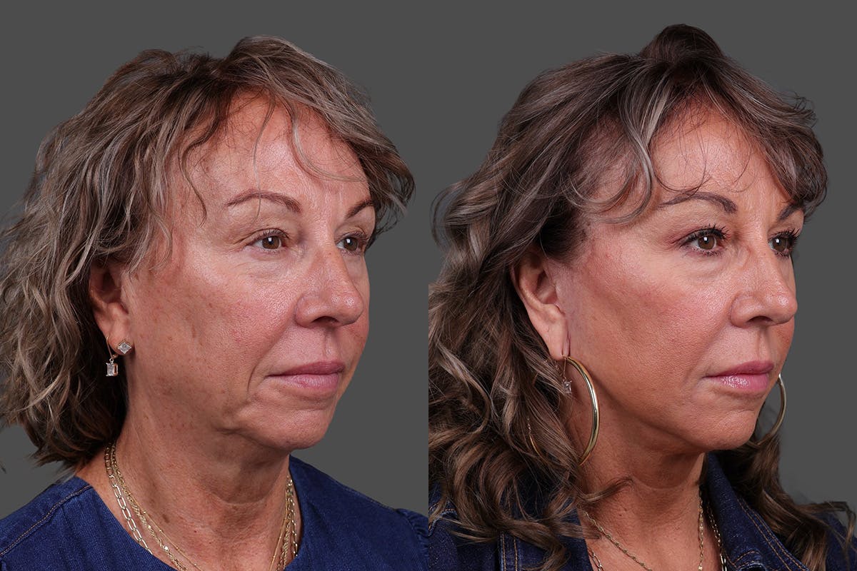 Limited Incision Facelift Before & After Gallery - Patient 290210 - Image 2