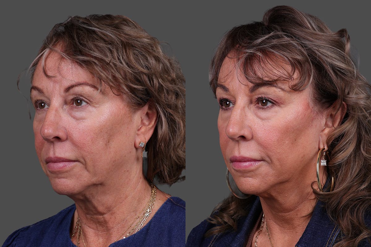 Limited Incision Facelift Before & After Gallery - Patient 290210 - Image 4