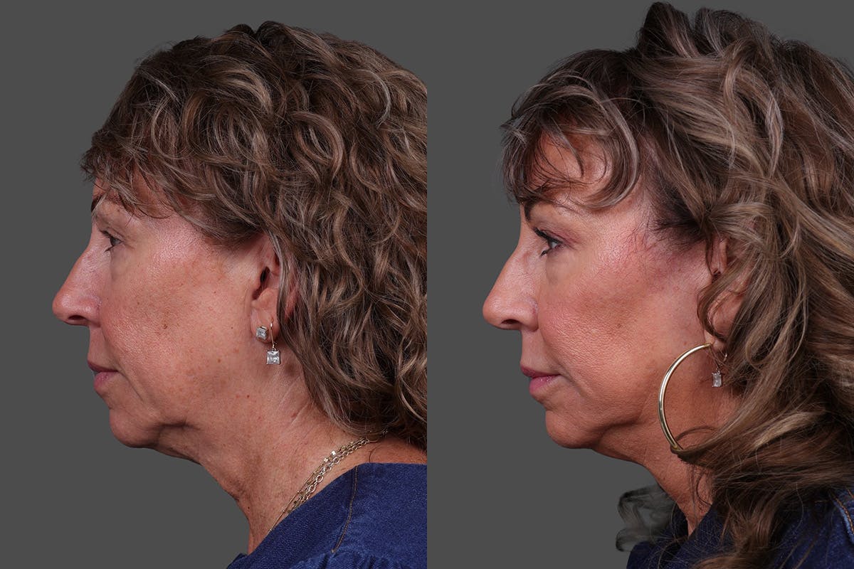 Limited Incision Facelift Before & After Gallery - Patient 290210 - Image 5