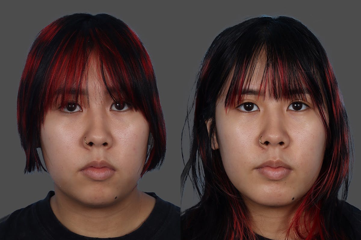 Chin and Cheek Augmentation Before & After Gallery - Patient 107140 - Image 1
