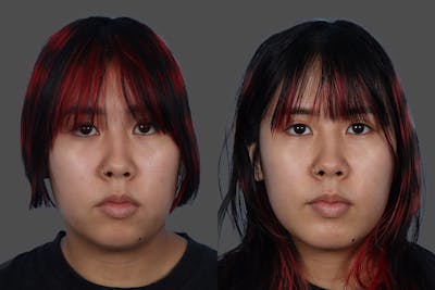 Chin and Cheek Augmentation Before & After Gallery - Patient 107140 - Image 1