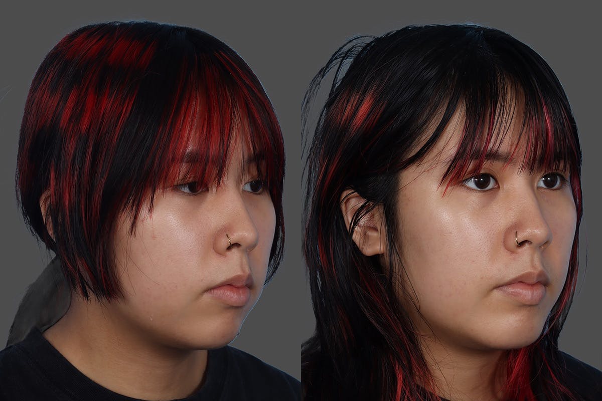 Chin and Cheek Augmentation Before & After Gallery - Patient 107140 - Image 2