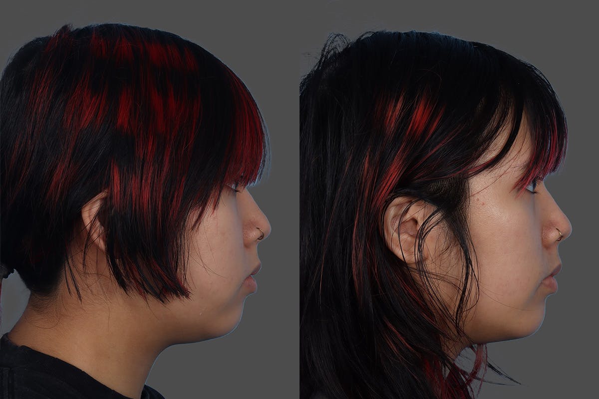 Chin and Cheek Augmentation Before & After Gallery - Patient 107140 - Image 3