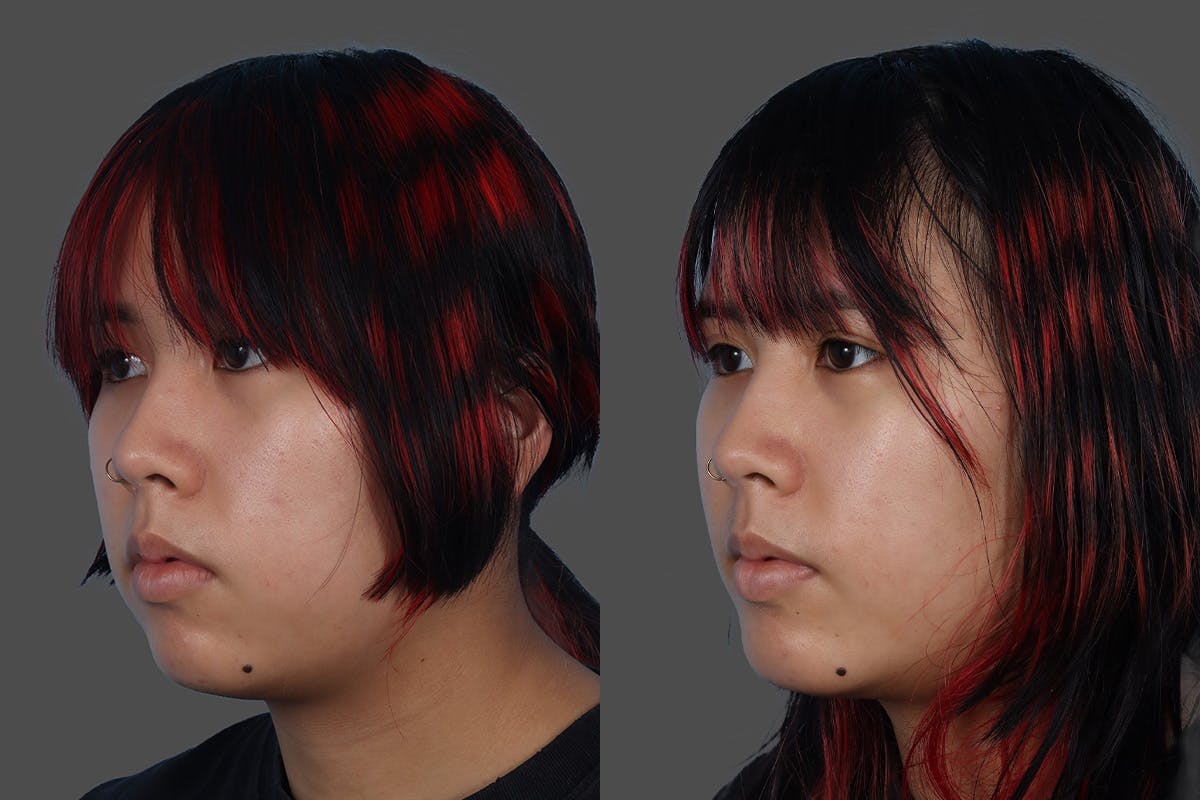 Chin and Cheek Augmentation Before & After Gallery - Patient 107140 - Image 4