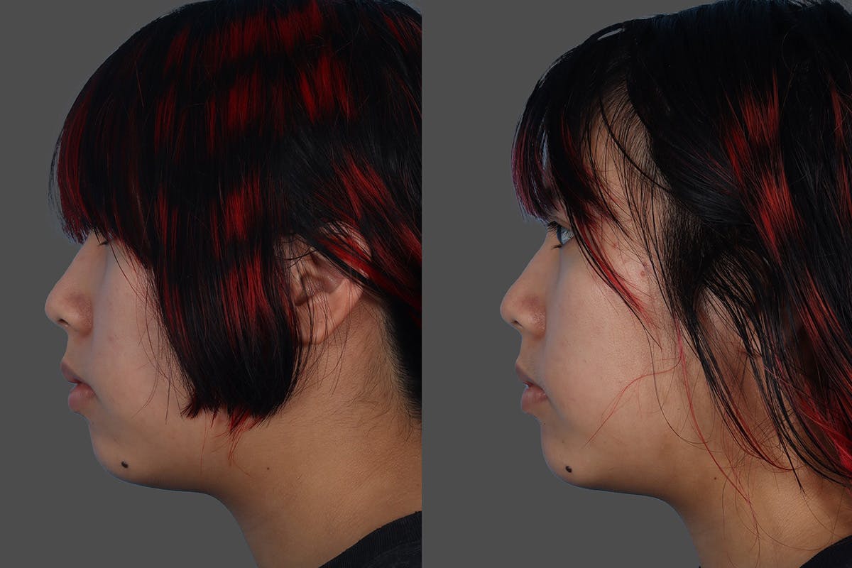 Chin and Cheek Augmentation Before & After Gallery - Patient 107140 - Image 5