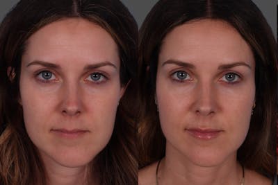 Botox Before & After Gallery - Patient 267678 - Image 1