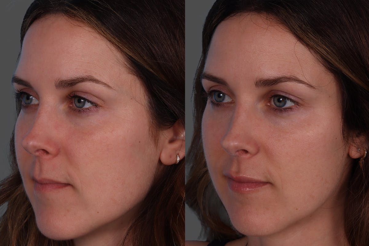Botox Before & After Gallery - Patient 267678 - Image 4