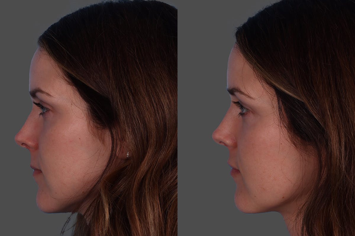Botox Before & After Gallery - Patient 267678 - Image 5