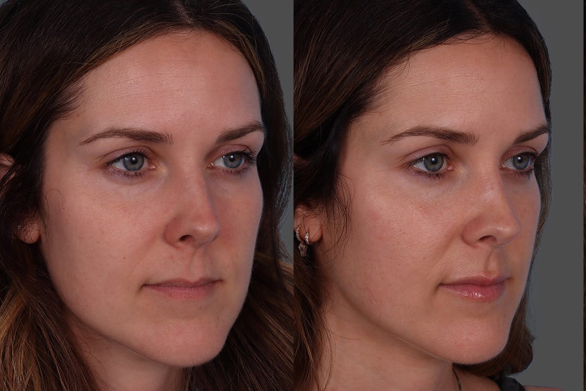Botox Before & After Gallery - Patient 267678 - Image 2