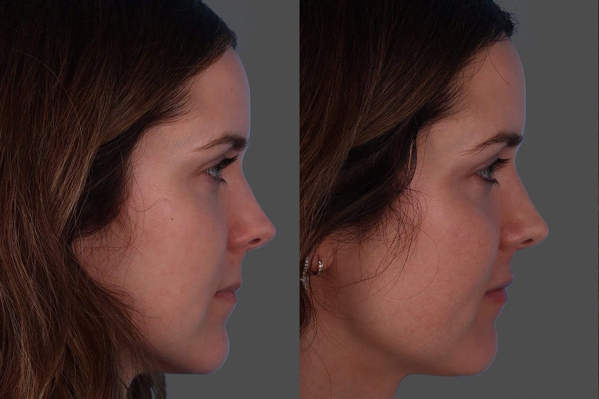 Botox Before & After Gallery - Patient 267678 - Image 3