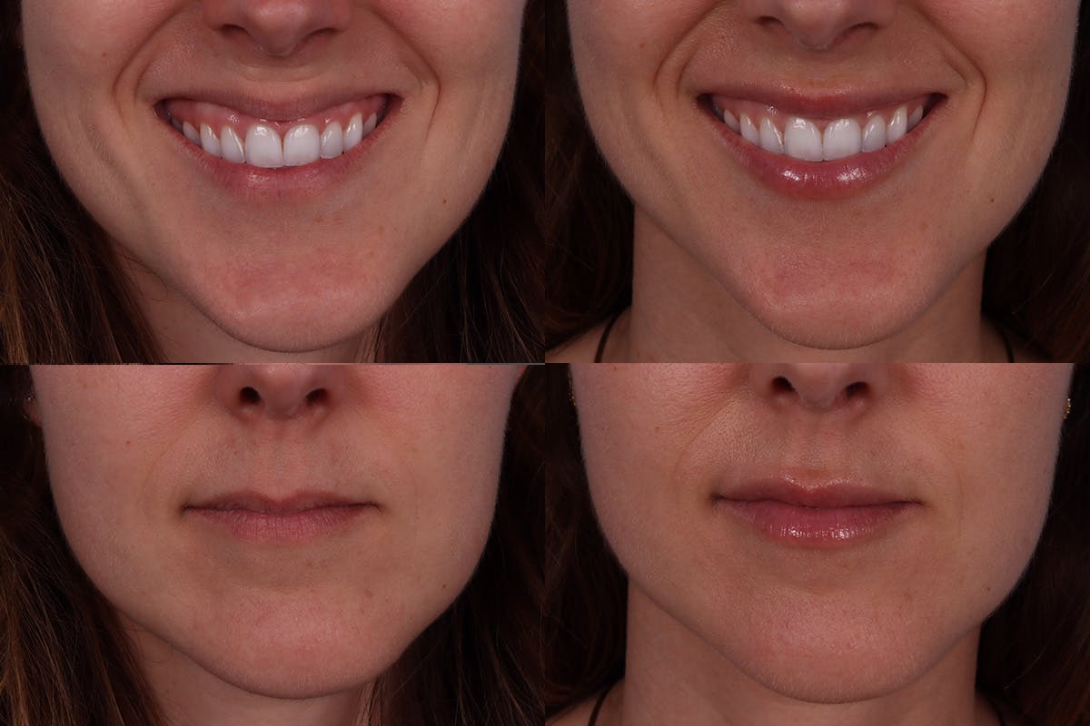 Botox Before & After Gallery - Patient 267678 - Image 6