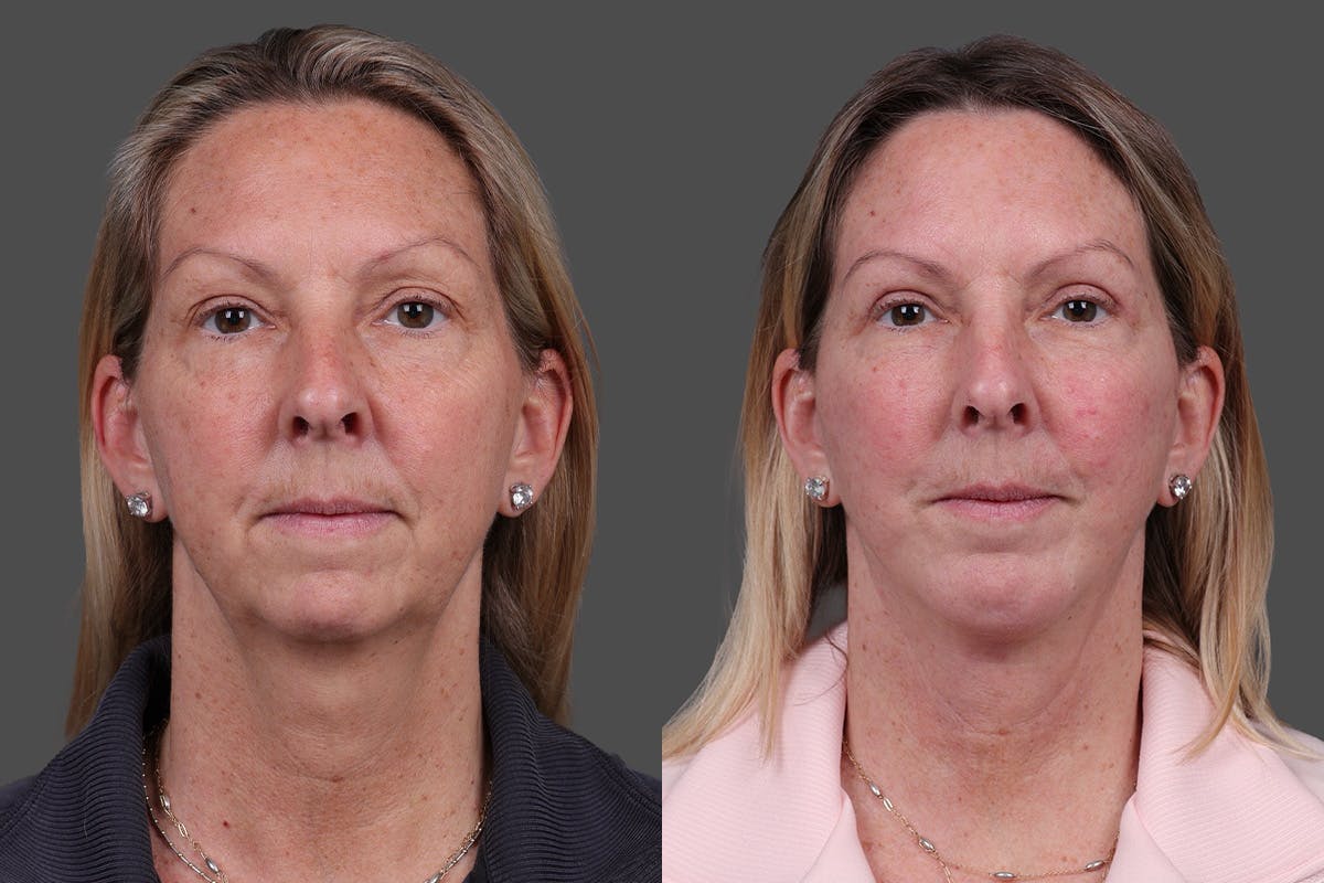 Chin and Cheek Augmentation Before & After Gallery - Patient 907973 - Image 3