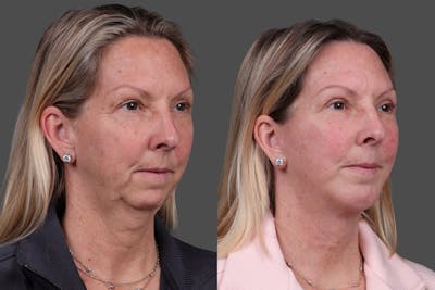 Chin and Cheek Augmentation Before & After Gallery - Patient 907973 - Image 1