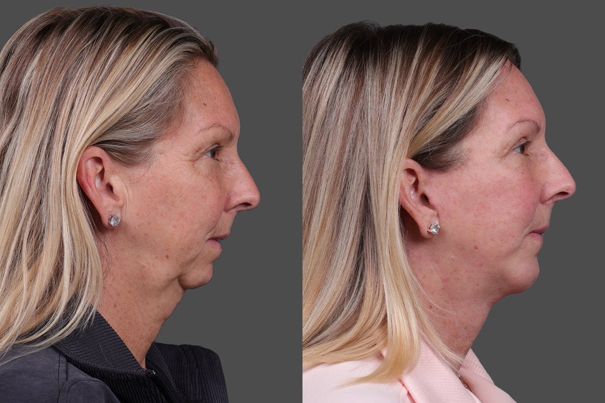 Chin and Cheek Augmentation Before & After Gallery - Patient 907973 - Image 4