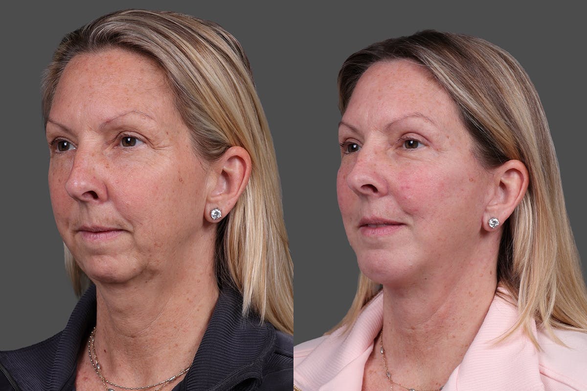 Chin and Cheek Augmentation Before & After Gallery - Patient 907973 - Image 2