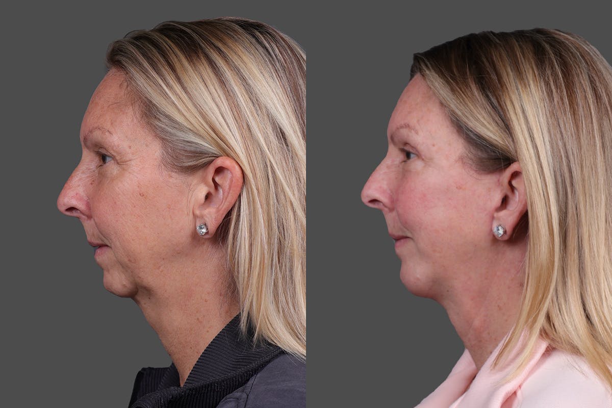 Chin and Cheek Augmentation Before & After Gallery - Patient 907973 - Image 5