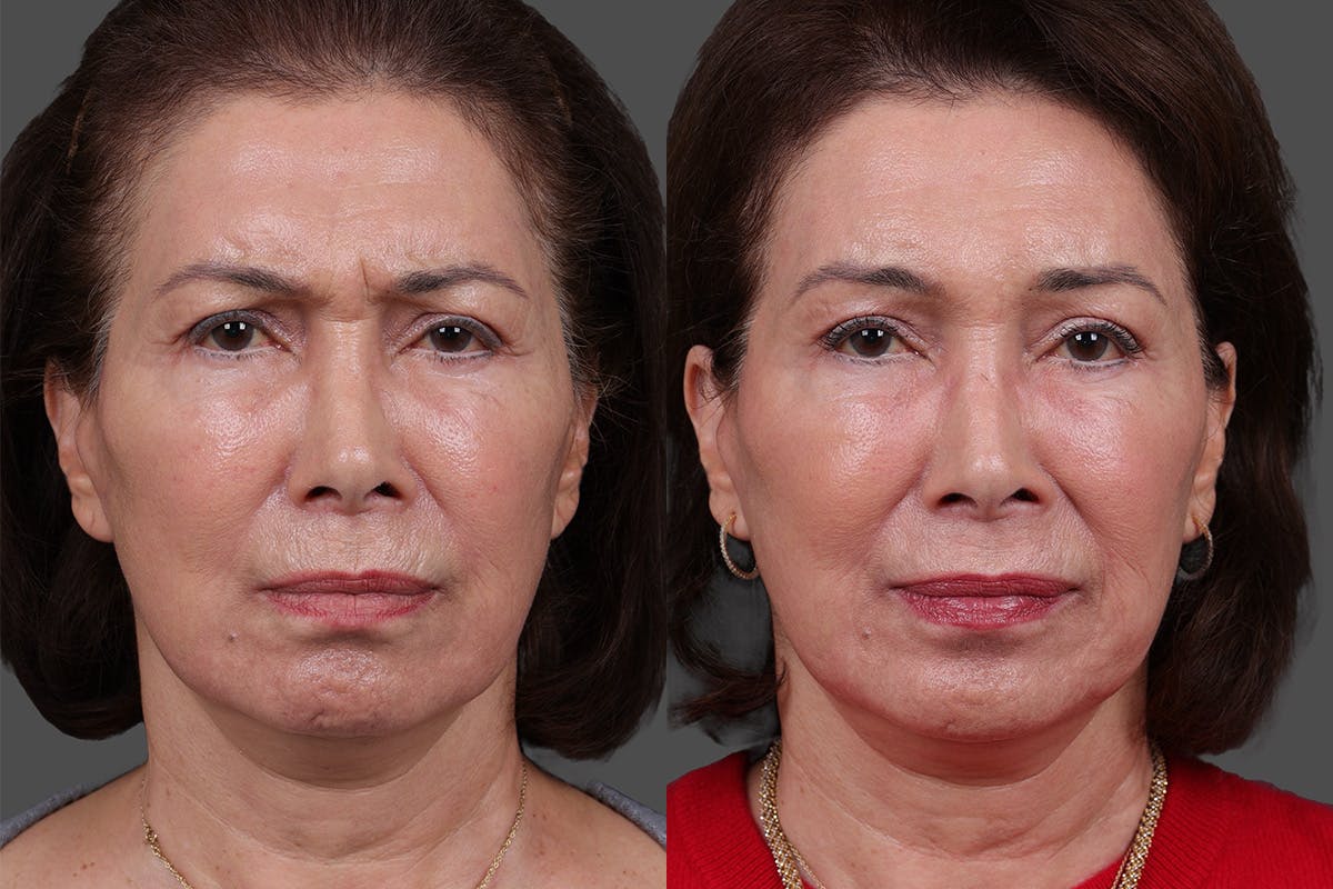 Daxxify Before & After Gallery - Patient 383083 - Image 4