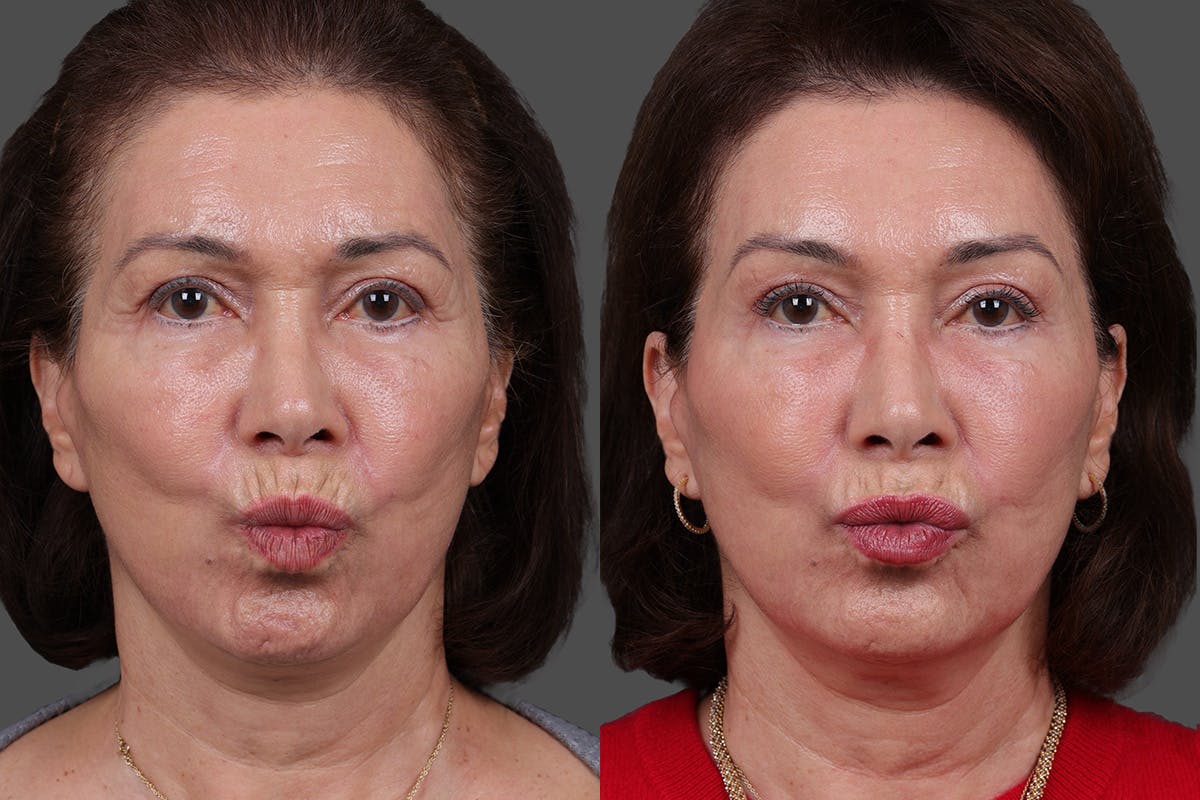 Daxxify Before & After Gallery - Patient 383083 - Image 3