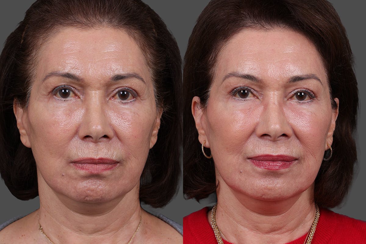 Daxxify Before & After Gallery - Patient 383083 - Image 1