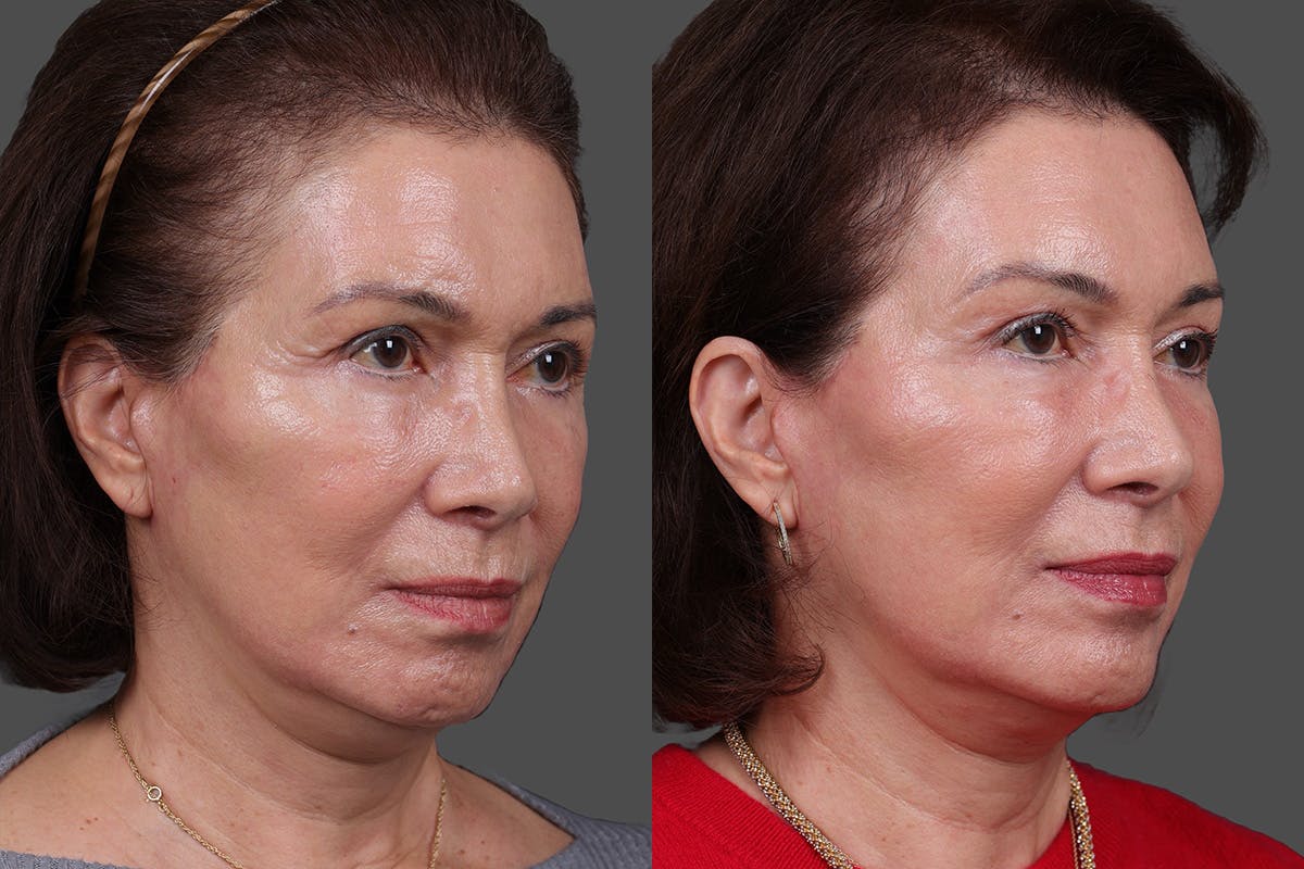 Daxxify Before & After Gallery - Patient 383083 - Image 5