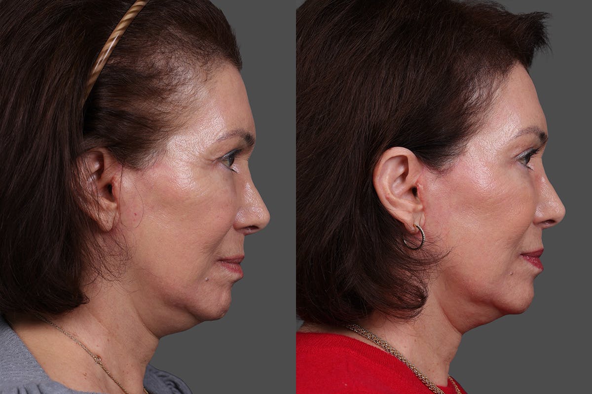 Daxxify Before & After Gallery - Patient 383083 - Image 6