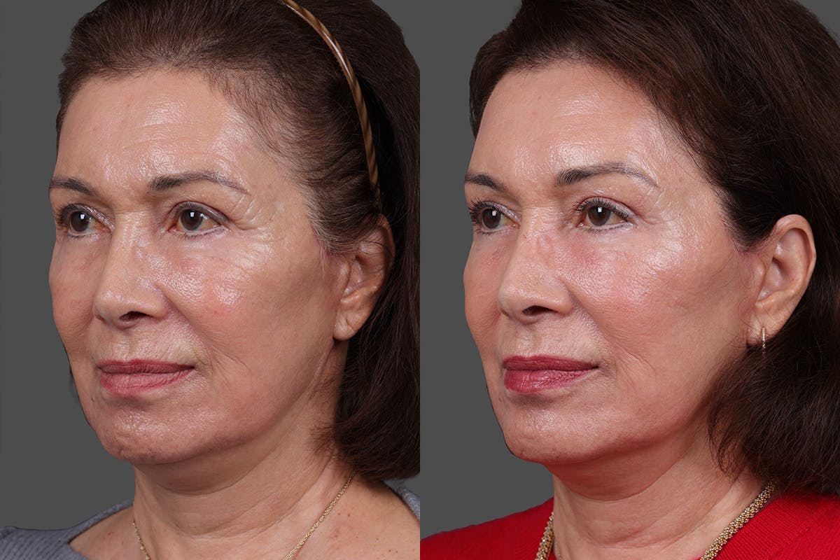 Daxxify Before & After Gallery - Patient 383083 - Image 7