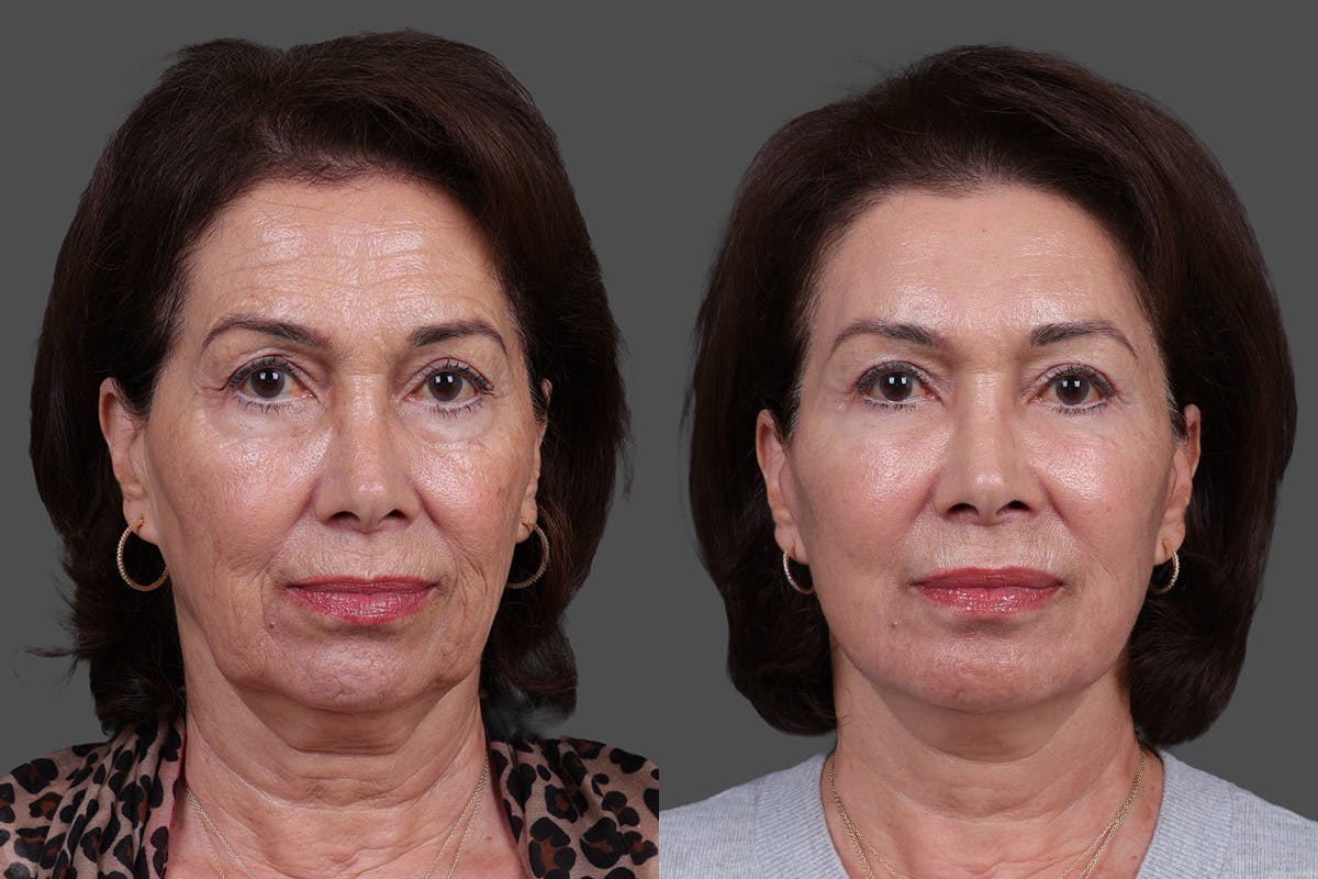 Facial Fat Transfer Before & After Gallery - Patient 446030 - Image 1