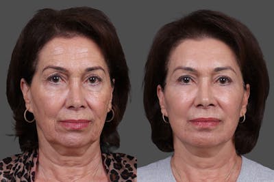 Facial Fat Transfer Before & After Gallery - Patient 446030 - Image 1